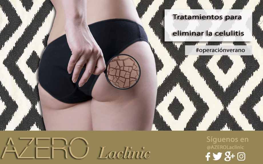 Tratamientos para eliminar la celulitis