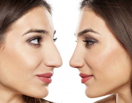 Rinoplastia