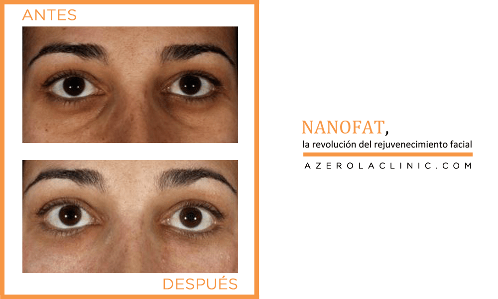 NANOFAT | La revolución del rejuvenecimiento facial