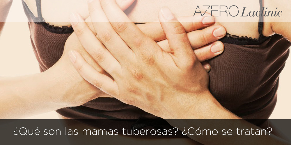 Las mamas tuberosas: qué son y cómo se tratan