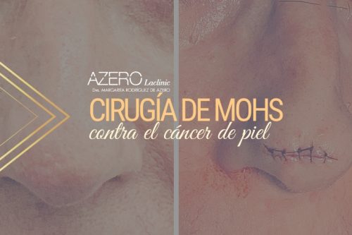 AZERO Laclinic realiza con éxito una cirugía de Mohs en Tenerife, técnica puntera para extirpar cáncer de piel.