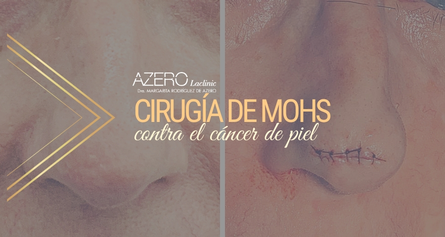 AZERO Laclinic realiza con éxito una cirugía de Mohs en Tenerife, técnica puntera para extirpar cáncer de piel.